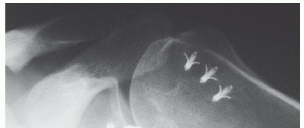 Illustration 33 for Bankart Repair & Inferior Capsular Shift: Solving Shoulder Instability