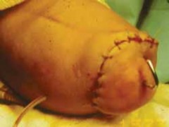 Adult Hip Reconstruction & Arthroplasty MCQs | Ortho Board