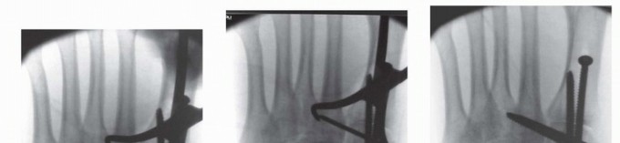 Illustration 19 for Fixation of Lisfranc Injuries: Essential Open Reduction Guide