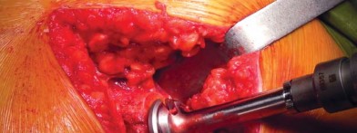 Illustration 38 for Unlock better THA: The technique of short stem for less invasiveness