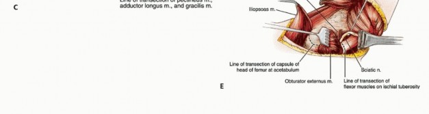 Illustration 13 for Mastering Hip Disarticulation: Through the Hip Joint Capsule