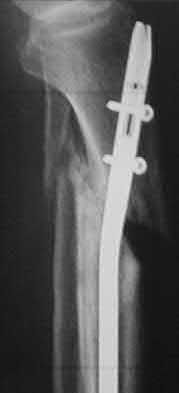 Illustration 137 for OrthoCash: Trauma MCQs & Cases for a yearold woman