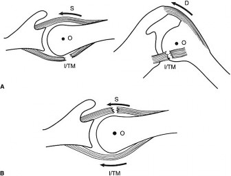 Illustration 2 for Unraveling Infraspinatus and Teres Rotator Cuff Tears