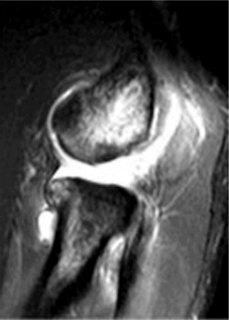 Illustration 2 for Elbow Cases: Unmasking Posterolateral Instability Pain