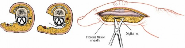 Illustration 162 for Essential Surgical Approaches: Uncover Every Aspect of the Wrist