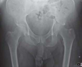 Illustration 64 for Navigating Early THA for Fractures of the Acetabulum