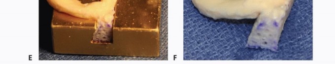 Illustration 13 for Symptomatic Knee? Meniscal Transplant for Anterior & Posterior Horns
