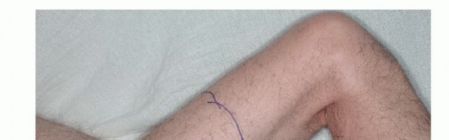 Illustration 10 for Limb-Sparing Quadriceps Resection: Superficial Femoral Artery