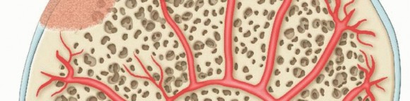 Illustration 9 for Dissecans of the Knee: What's the Difference – OCD vs. AVN?