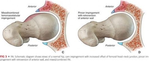Illustration 12 for Precision Hip Arthroscopy: Unlock Access to the Peripheral Compartment