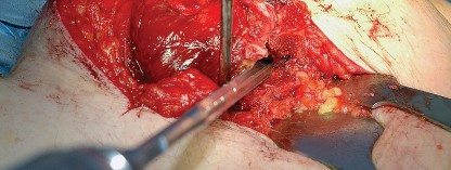 Illustration 52 for Unlock the Figure Posterior Approach to the Hip