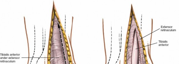 Illustration 12 for Optimized Approaches to the Dorsum of the Foot & Ankle