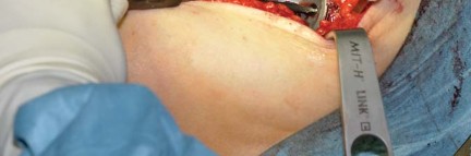 Illustration 26 for Collum Femoris Preserving: Achieve Better Primary Hip Outcomes