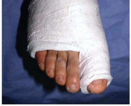 Illustration 15 for Restore Your Foot: Surgical Treatment for Hallux MP Joint Turf Toe