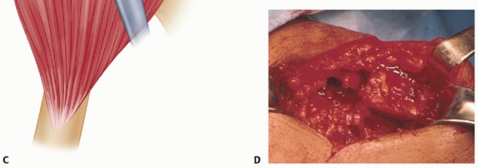 Illustration 12 for Subscapularis & Teres Rotator Cuff Repair: Advanced Techniques