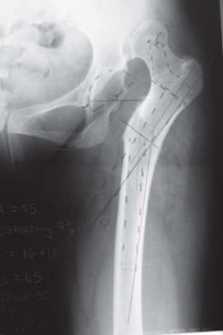 Illustration 29 for Successful Total Hip Replacement in Developmental Dysplasia