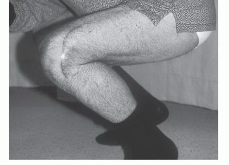 Illustration 25 for Avoid Major Surgery: Bone Tumor Treatment with Liquid Nitrogen Pour