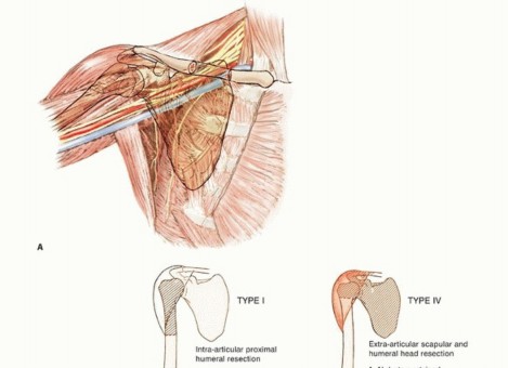 Illustration of proximal humerus resection - Dr. Mohammed Hutaif