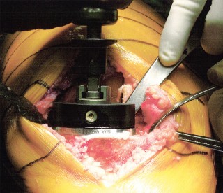 Illustration 20 for Minimally Invasive Subvastus: The Best Path to Quicker TKA Recovery
