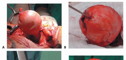 Illustration 12 for Hip Resurfacing: The Bone-Sparing Solution around the Femoral Head