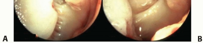 Illustration 16 for Medial Ankle Instability: Find Relief with Reconstruction