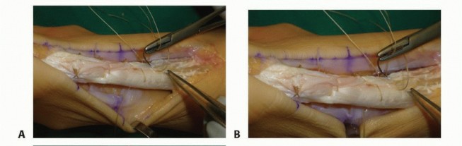 Open Management of Achilles: Your Guide to Lasting Relief