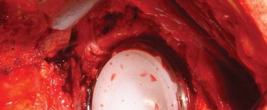 Illustration 18 for Posterolateral Surgical Approaches: Achieve Optimal Hip Replacement