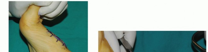 Illustration 10 for Mastering Midfoot Arthrodesis: Protect the Deep Neurovascular Bundle