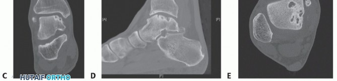 Illustration 24 for Unlock Healing: Medial Malleolar Osteotomy for Talus OLT Allografts