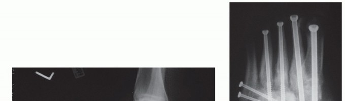 Illustration 22 for Regain Mobility: Surgical Solutions for Charcot Foot Arthropathy