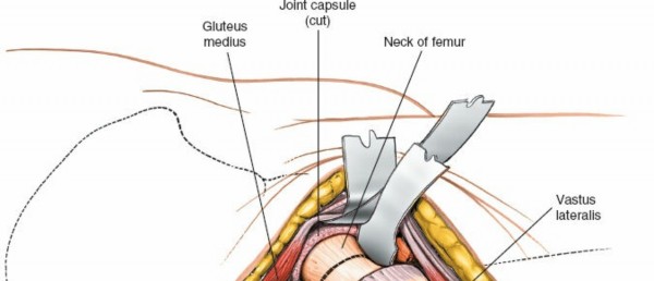 Illustration 140 for Unlocking Every Aspect of the Hip's Surgical Approaches