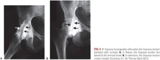 Illustration 52 for Stop the Snap: Hip Preservation for Snapping Iliopsoas Tendon