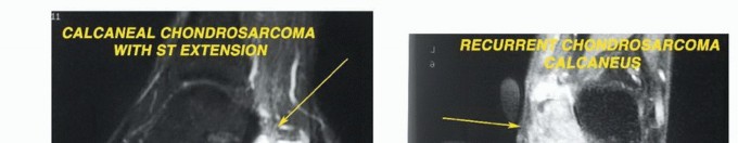 Illustration 9 for Treating Tumors of the Foot: Optimizing Amputation & Resection