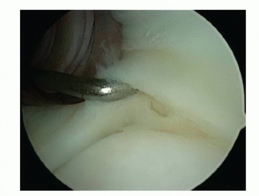 Relief for MDI: Expert Treatment of Multidirectional Shoulder Instability