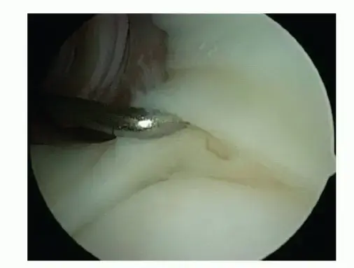 عدم استقرار الكتف متعدد الاتجاهات: دليل شامل للتشخيص والعلاج والتعافي مع الأستاذ الدكتور محمد هطيف