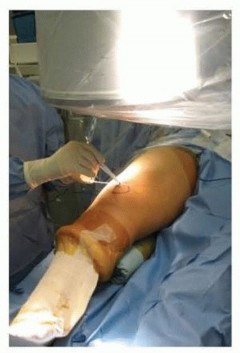 Precision Leg Length Correction: Percutaneous Epiphysiodesis Medially & Laterally