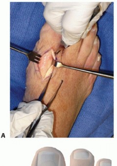 Illustration 14 for End Articular Cartilage Loss: Arthrosurface HemiCAP Resurfacing