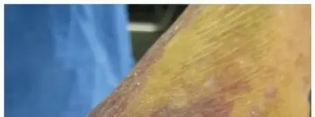 صورة توضيحية لـ مفتاح الشفاء: دليل شامل لاستبدال مفصل الكوع بعد الإصابات المعقدة