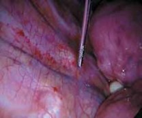 Illustration 14 for Mastering Anterior Interbody Arthrodesis with Instrumentation for Scoliosis
