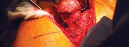 Illustration 47 for Metal on Metal Resurfacing: Enhanced Posterior Soft Tissue Repair