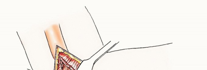 Illustration 37 for Restore Vital Function: Surgery for Type II Humeral Metastasis