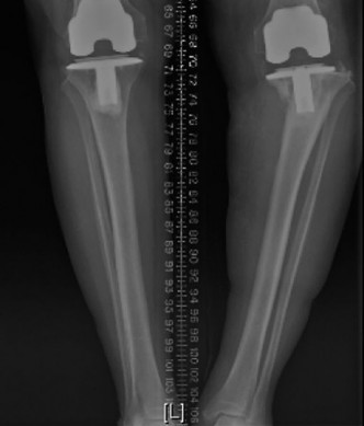Illustration 4 for Unraveling Your Painful TKR: Diagnosing Infection & Loosening