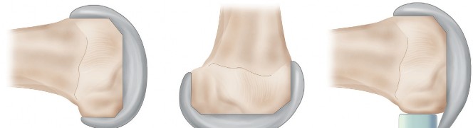 Illustration 19 for Understand Augments: The Role of Metal Augments in Arthroplasty