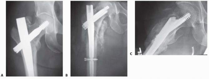 Illustration 27 for Achieve Optimal Femoral Head Fixation with Cephalomedullary Nailing