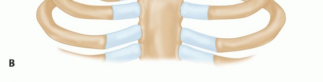 Illustration 11 for Optimizing SC Dislocation Repair After Medial Clavicle Resection