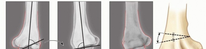 Is Supracondylar Humeral Osteotomy Right for Cubitus Varus?