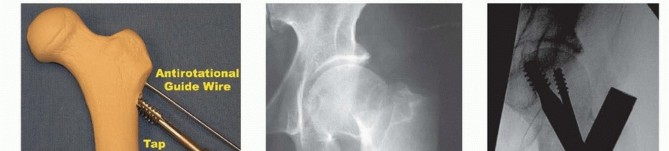 Illustration 23 for Is a Sliding Hip Screw Best for Your Femoral Neck Fracture?