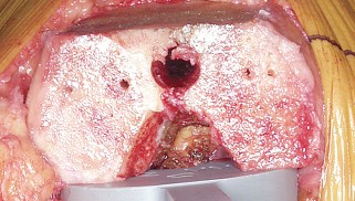 Illustration 43 for Mastering Valgus Total Knee Replacement: Techniques & Pitfalls