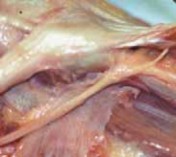 Illustration 14 for Percutaneous Epiphysiodesis: Precisely Closing the Third of the Physis