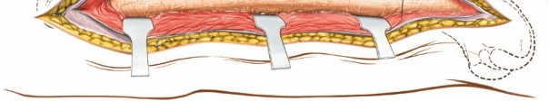 Illustration 12 for Optimal Femoral Approaches: Mastering the Lateral Intermuscular Septum